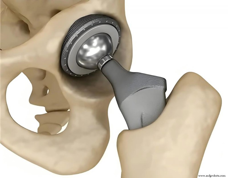 Usinagem Adaptativa para Implantes de Ti6Al4V: Eliminando Vibração e Aperfeiçoando Qualidade